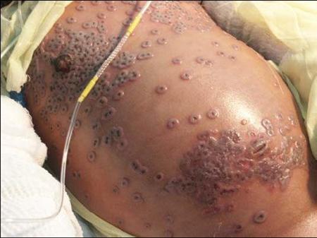 2 Year Old Smallpox Reuters